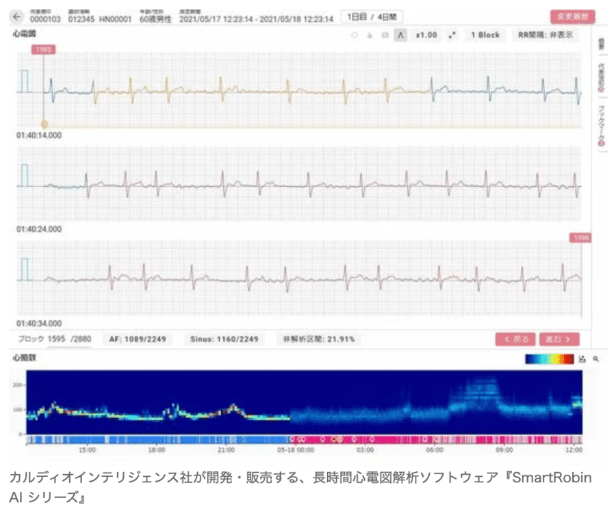 AIの心電図解析ソフトウェア